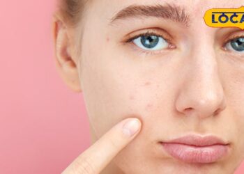 क्या डार्क सर्कल ने छीन ली चेहरे की रंगत? मेकअप नहीं…अब आलू से आएगा निखार, जानें कैसे