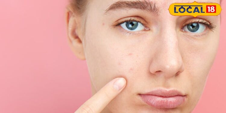 क्या डार्क सर्कल ने छीन ली चेहरे की रंगत? मेकअप नहीं…अब आलू से आएगा निखार, जानें कैसे